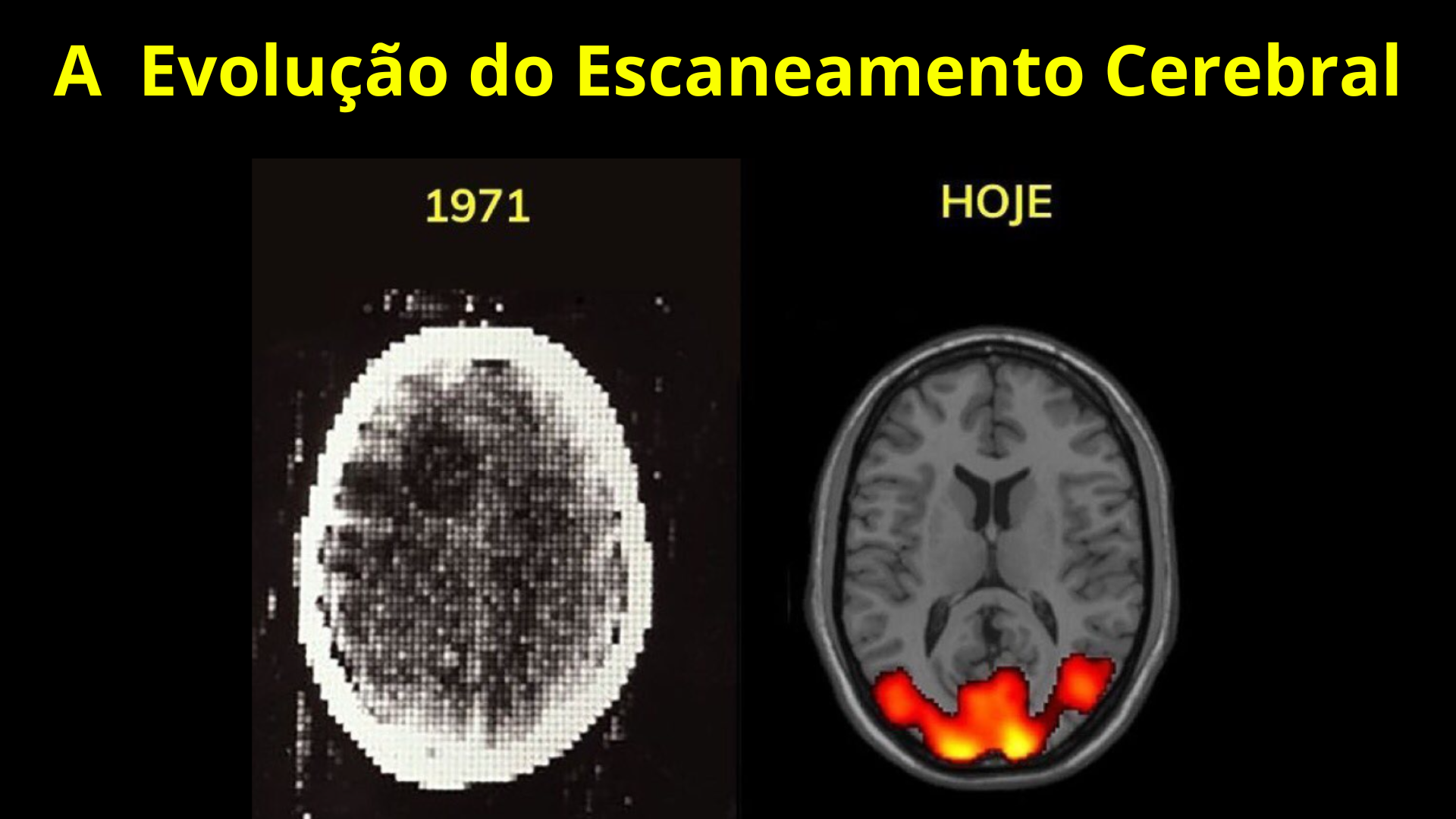A Evolução do Escaneamento Cerebral (1)